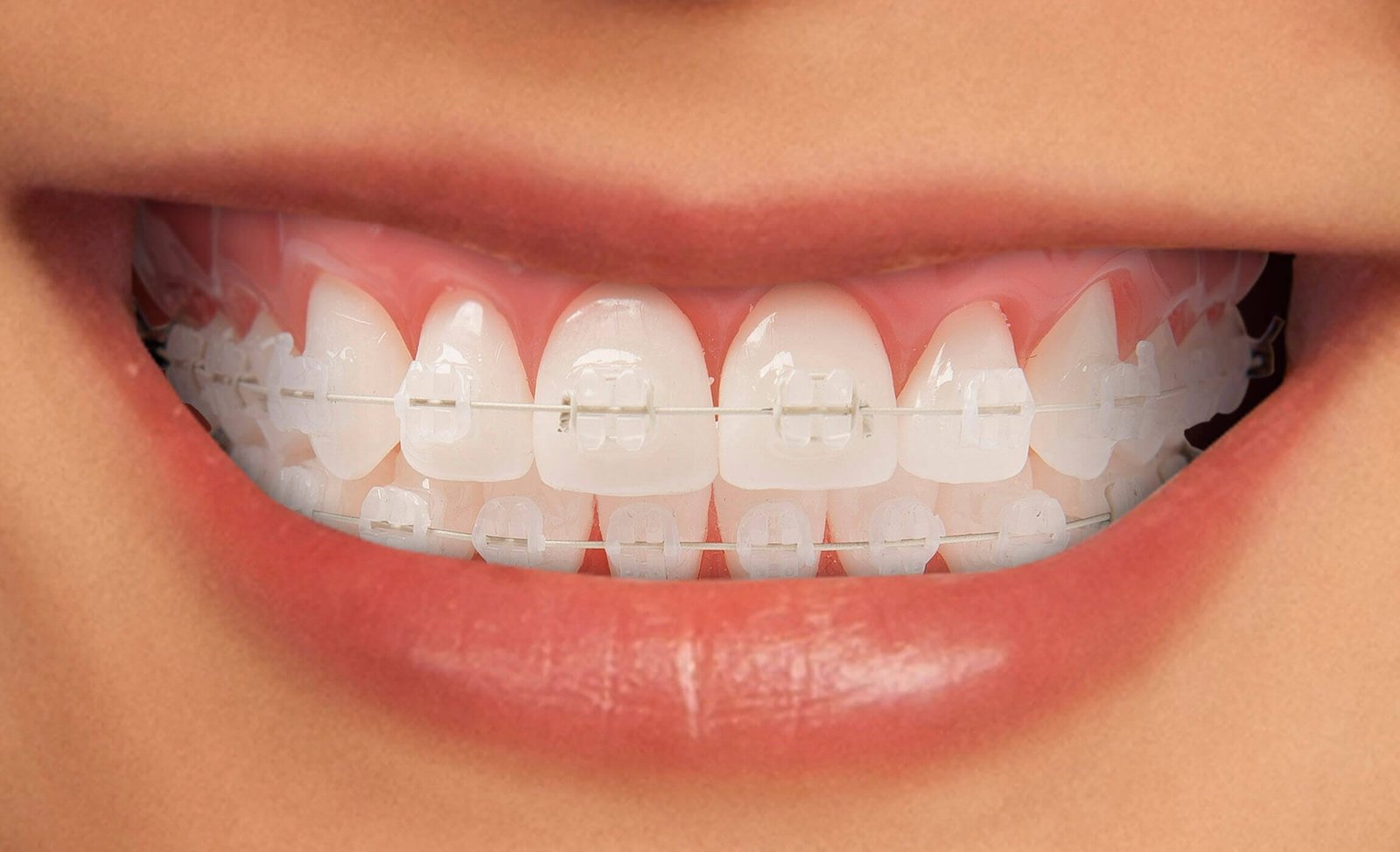 brackets-ceramicos brackets ceramicos